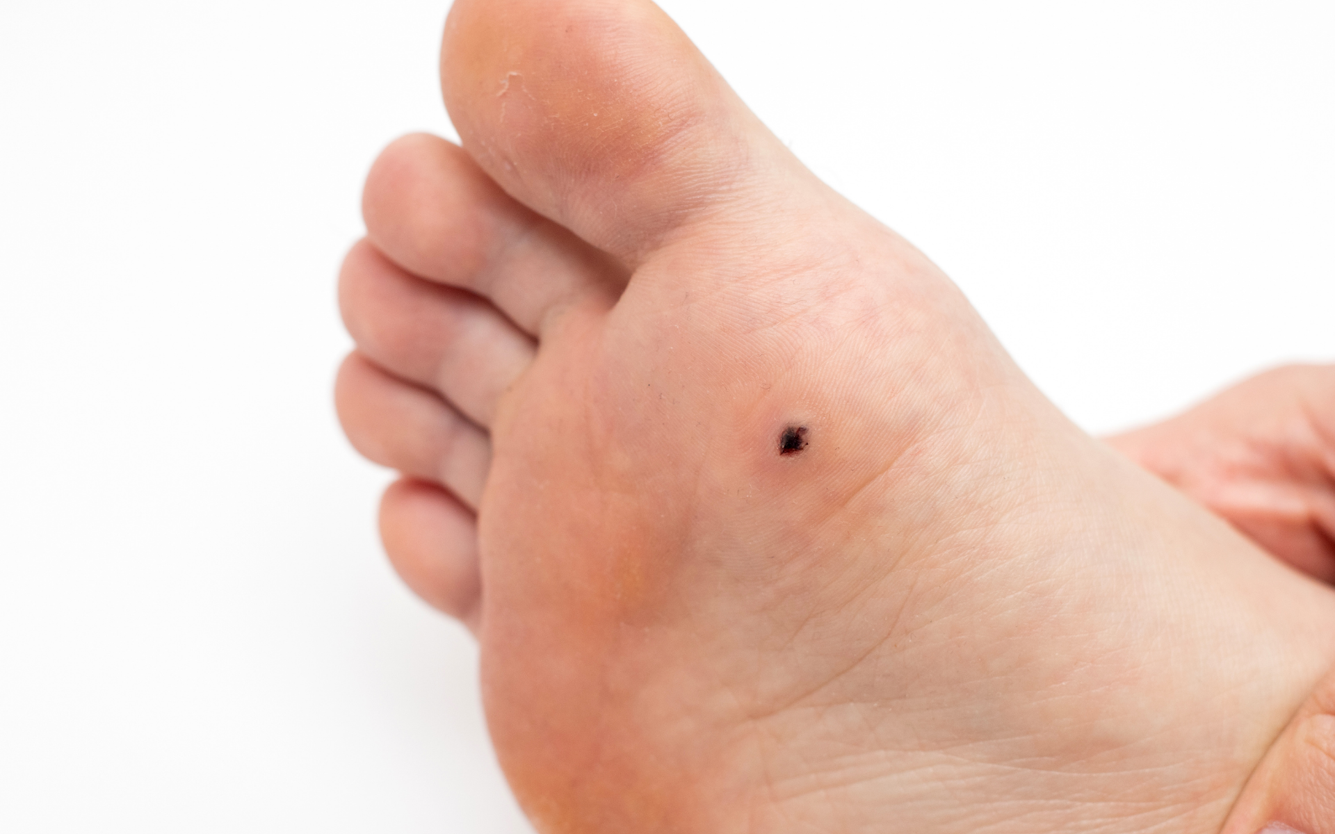 foot plantar wart removal by steady gait foot clinic in Scarborough Ontario