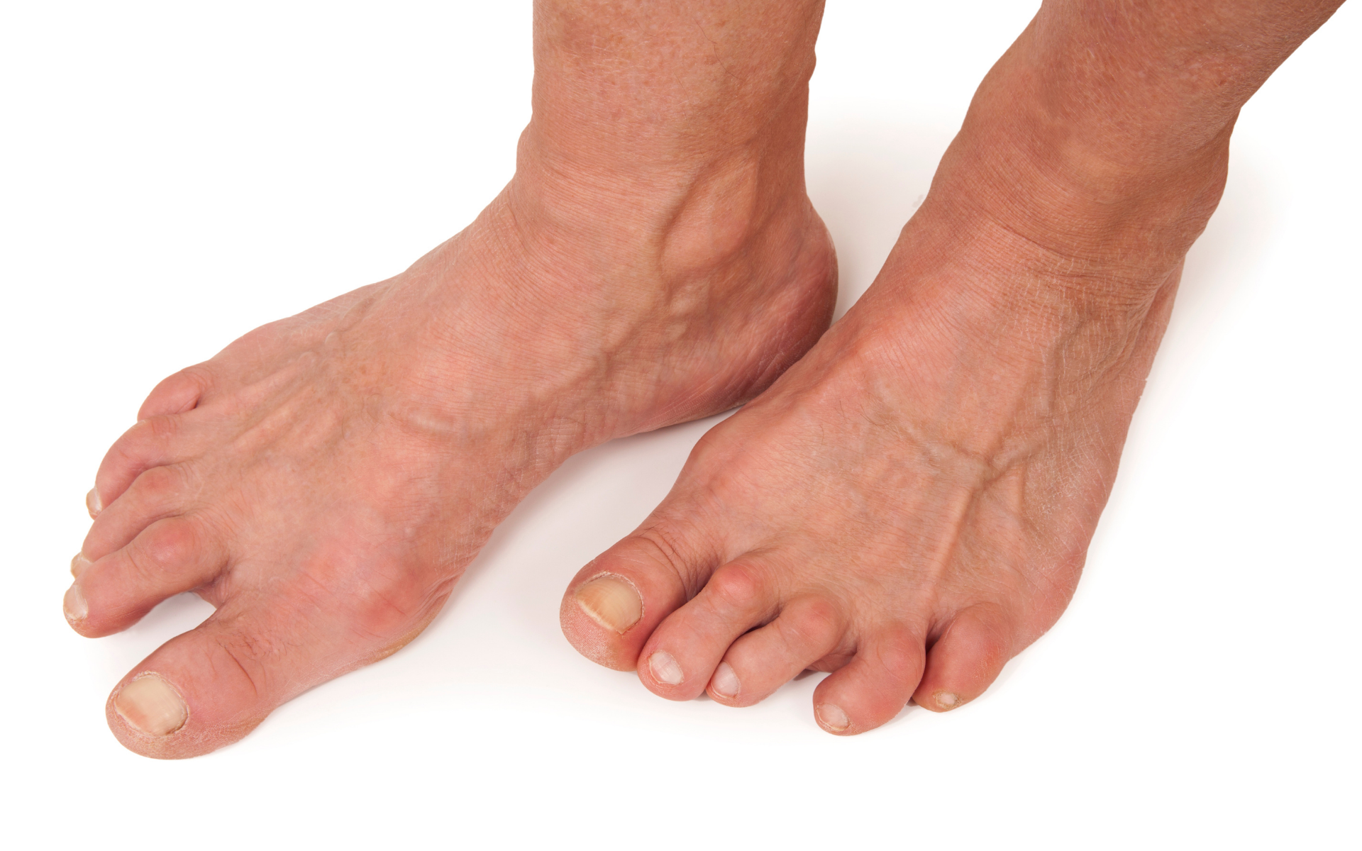 diabetic and arthritis foot care by steady gait foot clinic in Scarborough Ontario