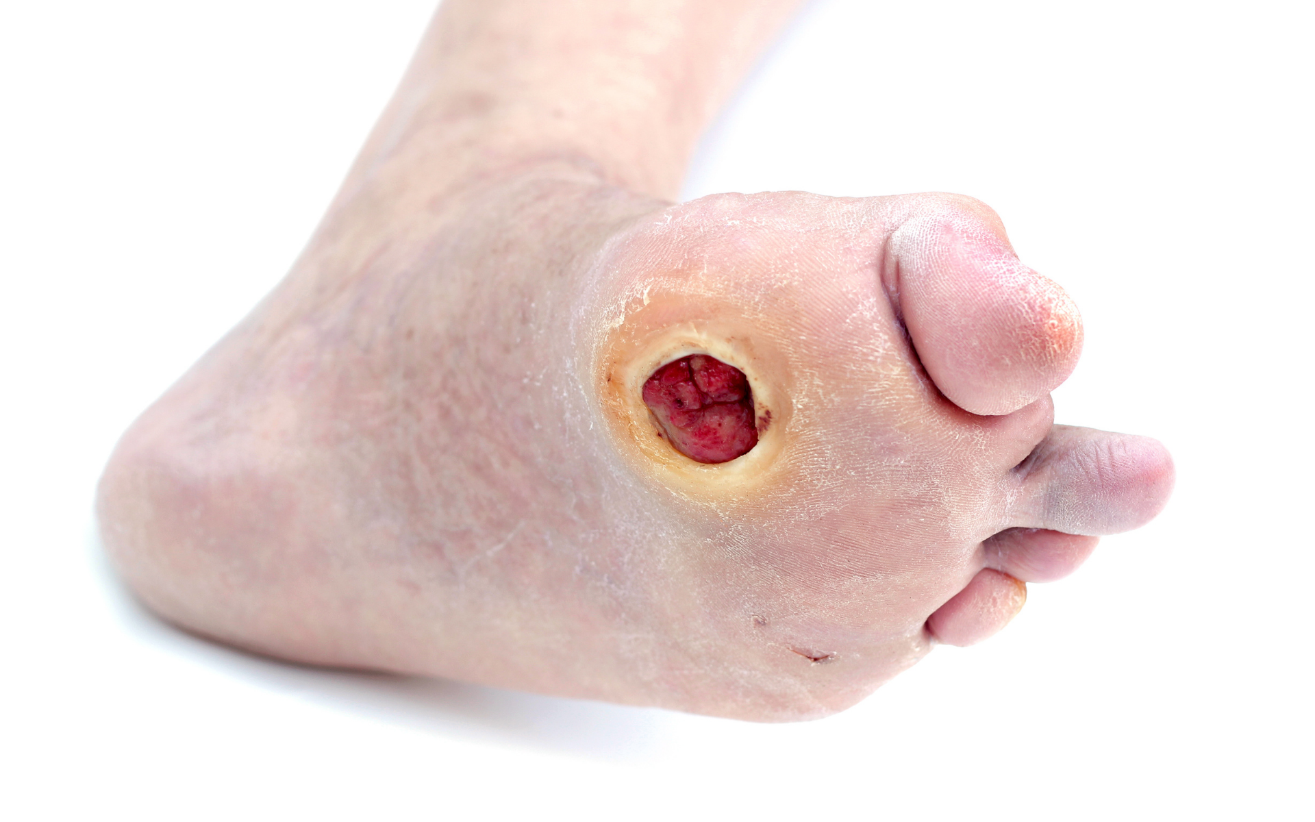 foot ulcer care and treatment by steady gait foot clinic in Scarborough Ontario