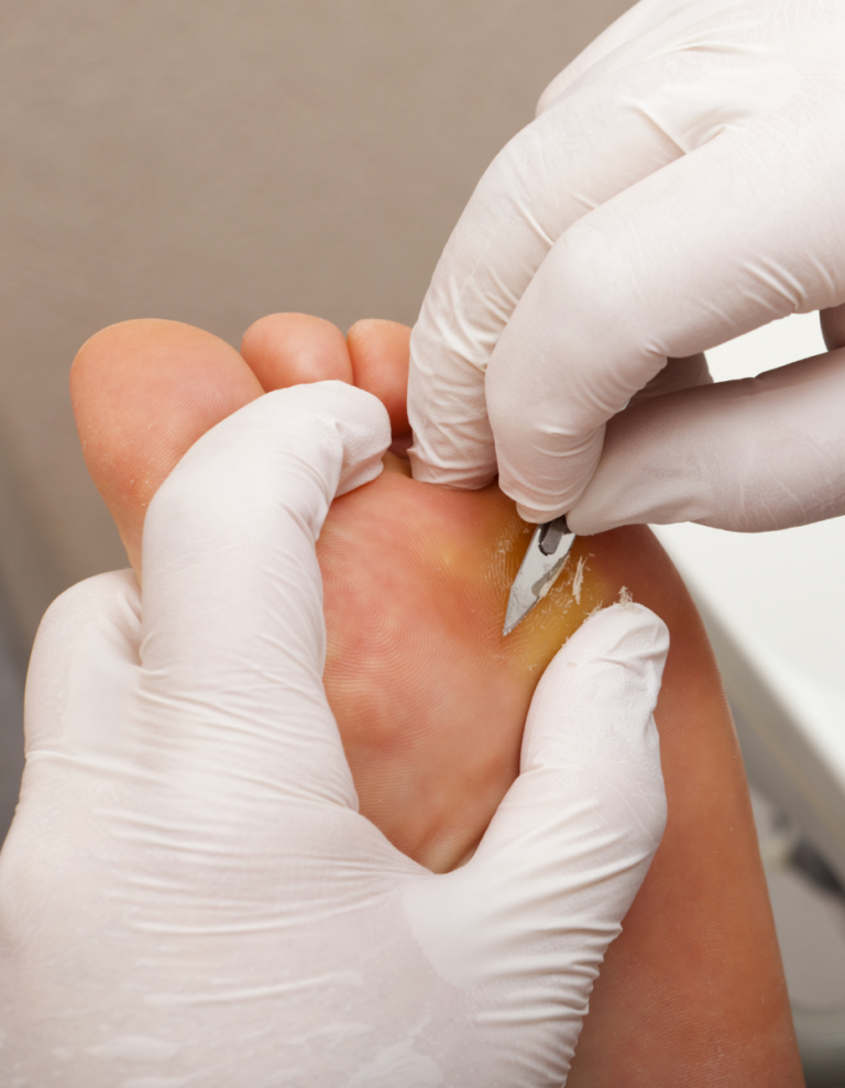 Foot Plantar Warts Removal | By Steady Gait Foot Clinic in Scarborough